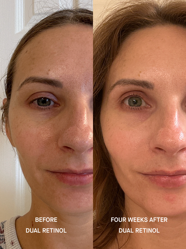Split photo labelled BEFORE DUAL RETINOL and FOUR WEEKS AFTER DUAL RETINOL, the same face at matched framing. Skin texture looks smoother and more even in the right frame.
