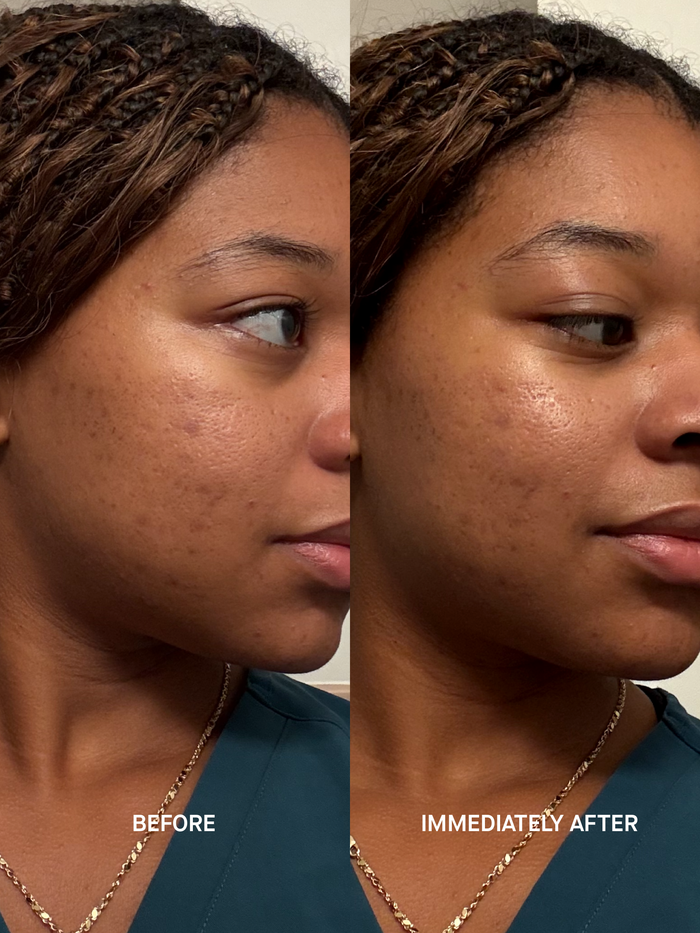 Side-by-side photographs of the same woman's cheek in three-quarter profile, wearing teal scrubs. The left frame, captioned BEFORE, shows uneven tone and visible acne scarring. The right frame, captioned IMMEDIATELY AFTER, shows the same cheek with the tint applied, covering the scarring for a light, luminous finish.