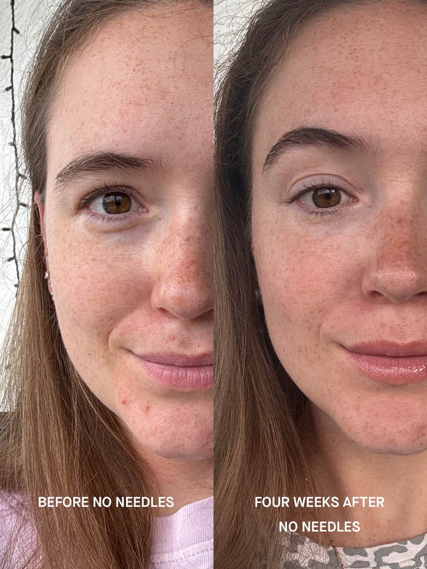 Split before and after photograph of a woman&rsquo;s face, captioned BEFORE NO NEEDLES and FOUR WEEKS AFTER NO NEEDLES. The after half shows calmer, smoother-looking skin with less redness.
