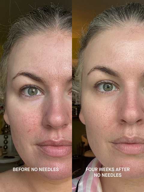 Customer before and after using Brandefy No Needles Renew Serum, four weeks apart.