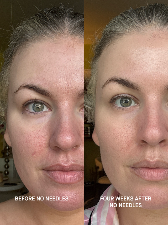 Split photo of the same face before and after four weeks of using No Needles. Redness around the nose and cheek is reduced and the skin texture looks smoother in the right frame.