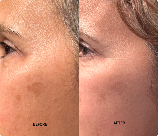 Customer before and after using Brandefy Clinical Vit C + E + Ferulic Defend Serum