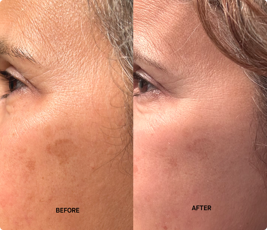 Customer before and after using Brandefy Clinical Vit C + E + Ferulic Defend Serum