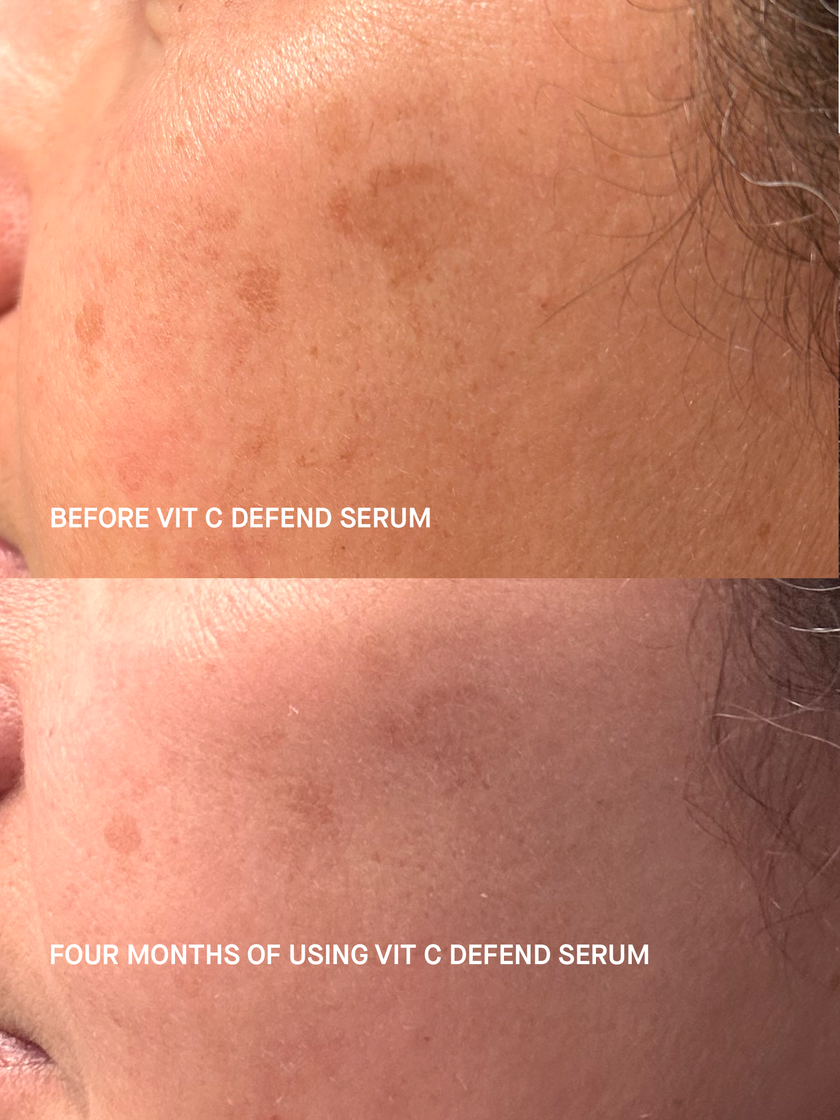 Split before-and-after close-up of a cheek. The upper half, labelled before using Vit C Defend Serum, shows several distinct brown sun spots; the lower half, labelled four months of using Vit C Defend Serum, shows the same spots visibly faded.